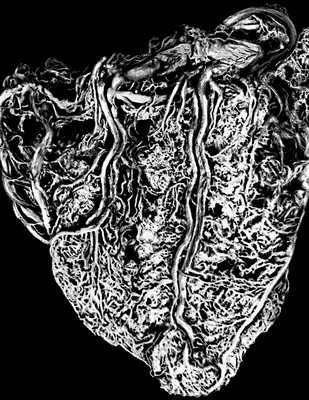 Рис. 6а. Кровеносные сосуды задней стенки здорового сердца (инъецированы цветным латексом). По Сердце В. Самойловой. Сердце.